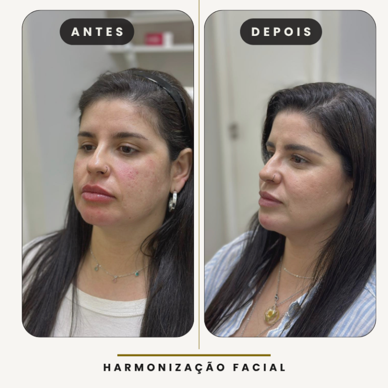 ANTES (4)